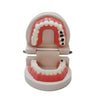 Dental Study Teaching Teeth Model Rotten Tooth Decay Caries Care Dentist Equipment Denture